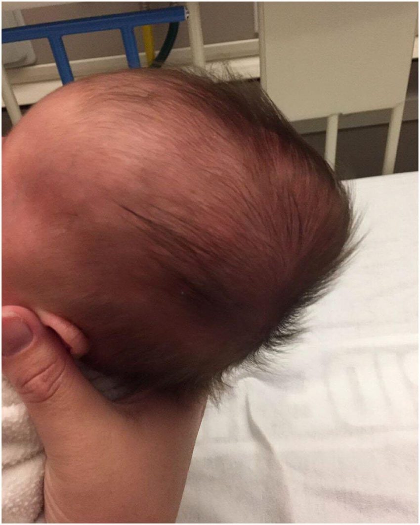 Caput Succedaneum Cross Suture Lines - Harptimes.com