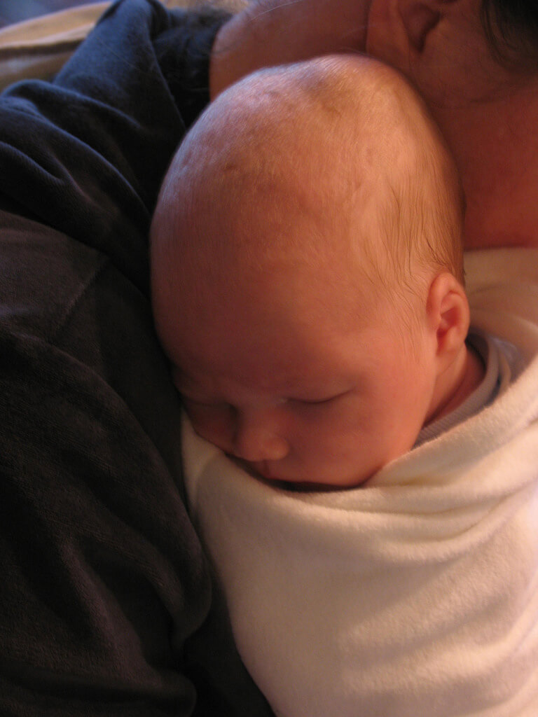 Caput Succedaneum The Symptoms of Cephalohematoma - lawncrib.com