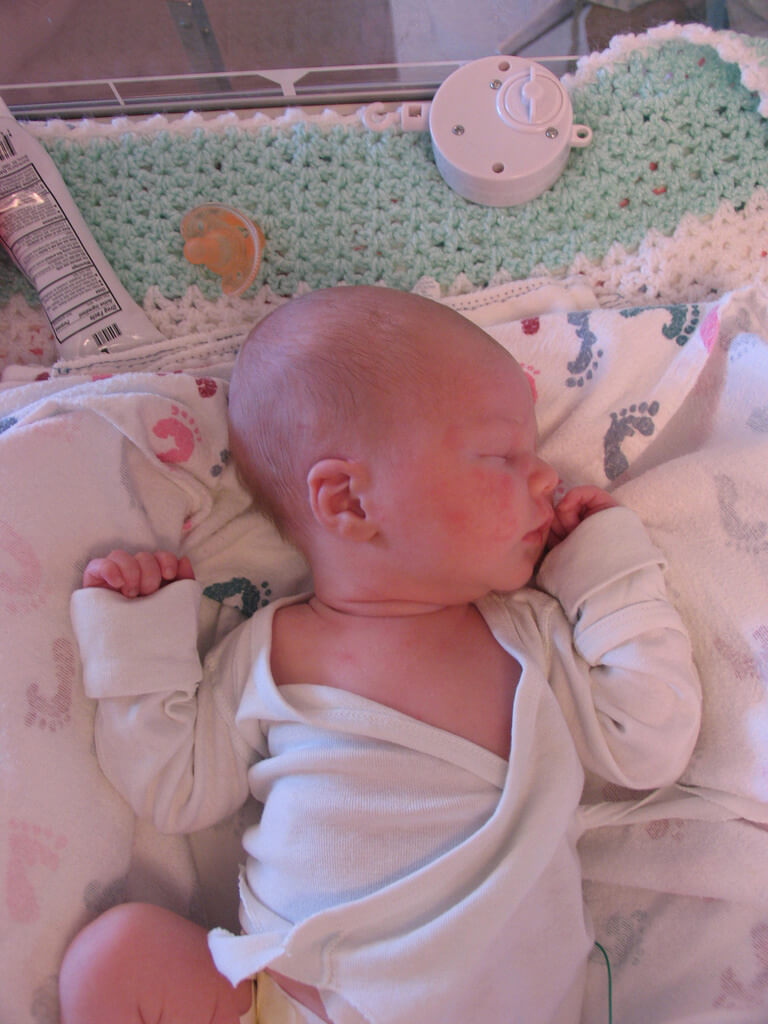 Caput Succedaneum Treatment for Cephalohematoma - Harptimes.com